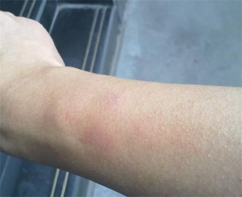 新房入住甲醛超标身体现象